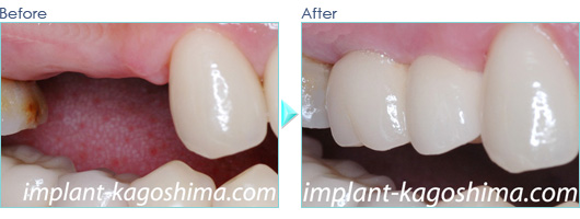 抜歯即時のインプラント症例20090121