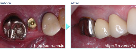 抜歯即時のインプラント症例20090808
