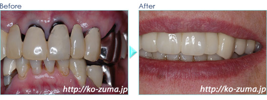 前歯のインプラント症例20100729