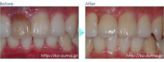 前歯のインプラント症例20110106