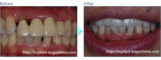 前歯のインプラント症例20111005