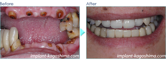 無歯顎のインプラント症例20090202-1