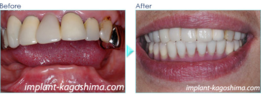 無歯顎のインプラント症例20090202-2