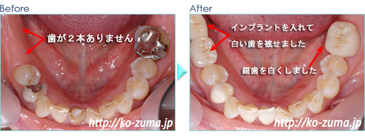 奥歯のインプラント症例20090618