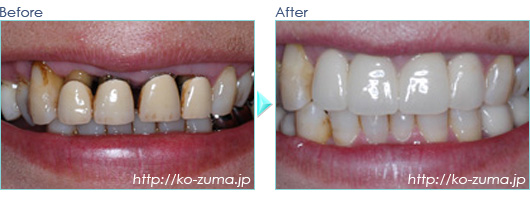 奥歯のインプラント症例20090622