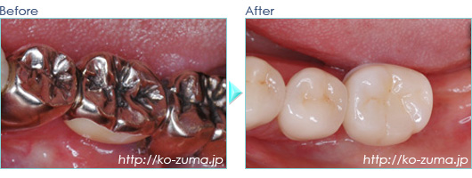 奥歯のインプラント症例20090627