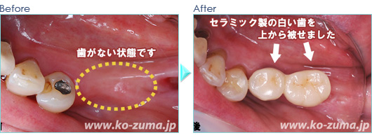 奥歯のインプラント症例20090711