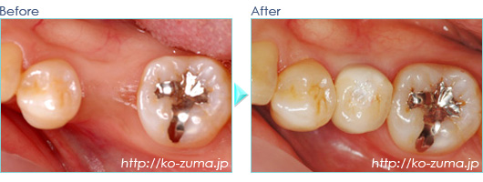 奥歯のインプラント症例20110109