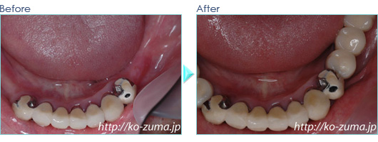 奥歯のインプラント症例20110716