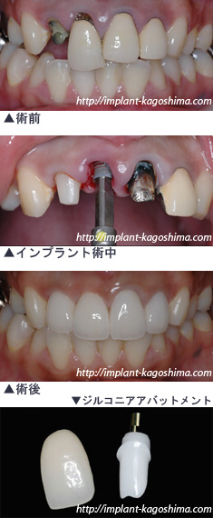 歯ぐきの術前後及びジルコニアアバットメント画像